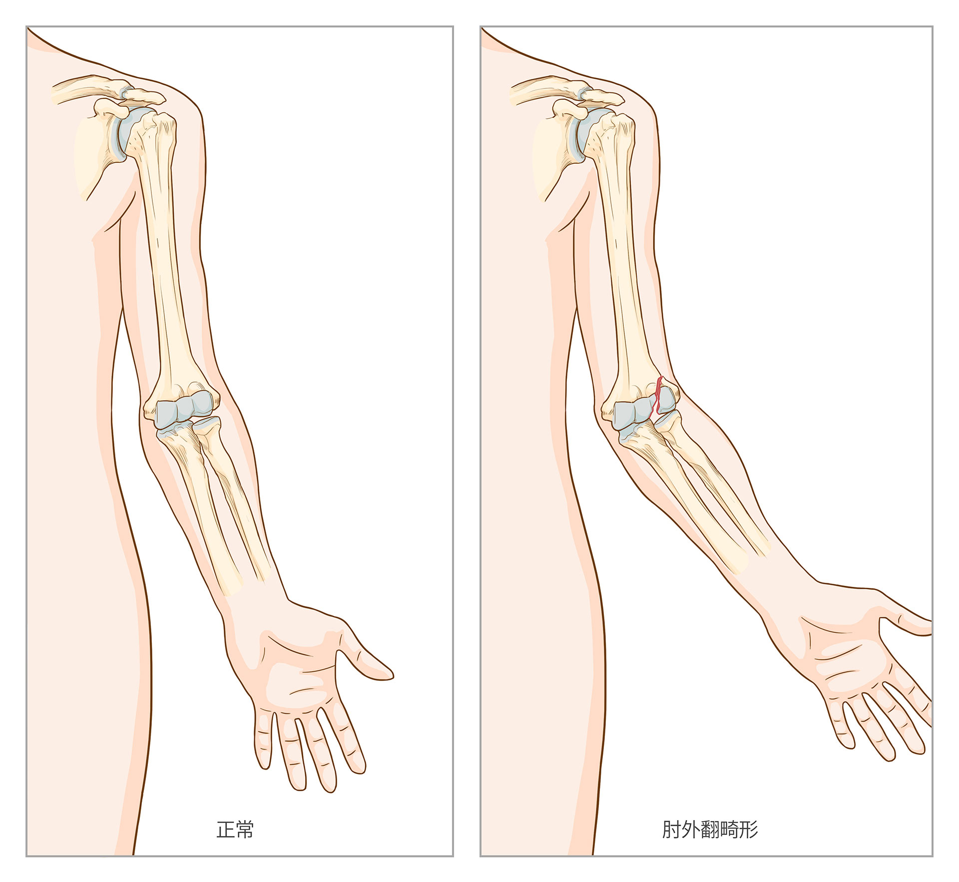 了解症状 肱骨外髁骨折介绍 疾病百科 百科名医