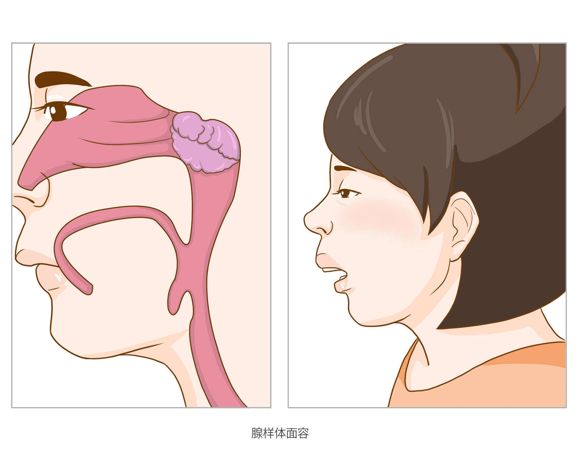 了解症状 腺样体肥大介绍 疾病百科 百科名医