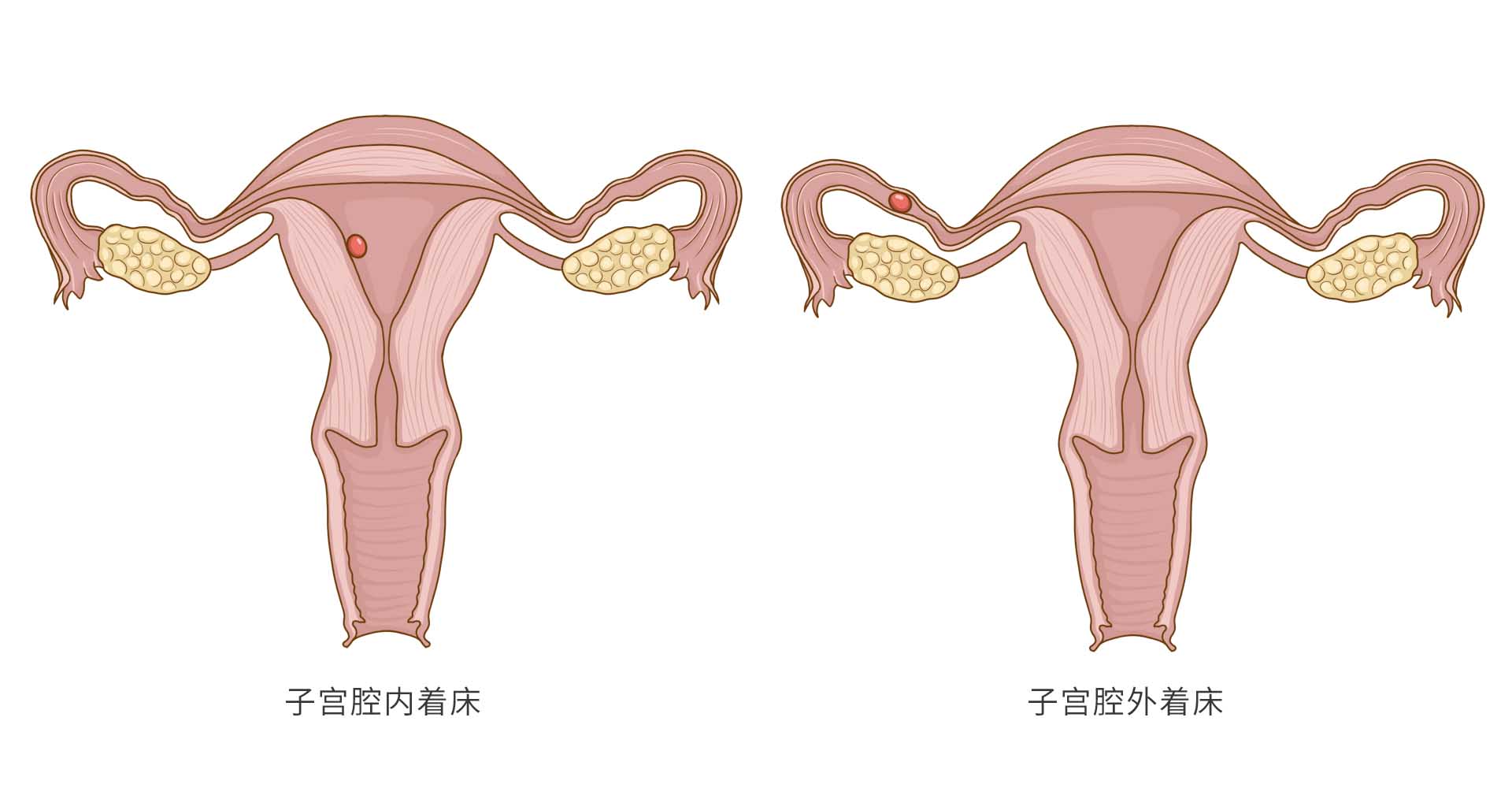 什么是异位妊娠 异位妊娠介绍 疾病百科 百科名医