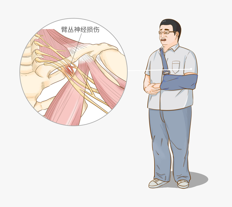 臂丛神经痛的治疗 有没有特效药 锻炼主要动作 学堂在线健康网